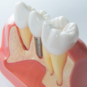 Zubní implantáty na celý život